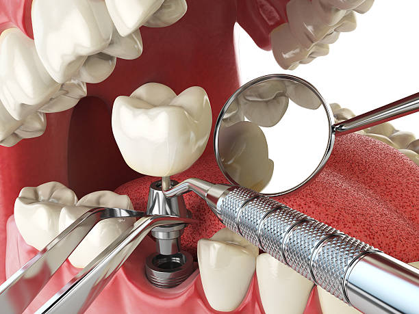 Best Emergency Dentist for Lost Fillings or Crowns in Springtown, TX